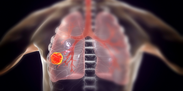 Screening and Detection Screening and Detection